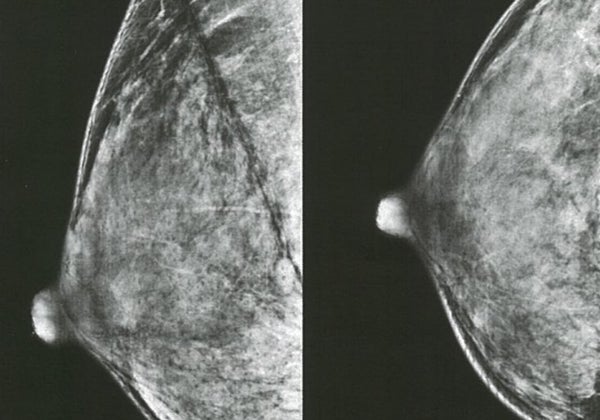 La inteligencia artificial, tan eficaz como dos radiólogos buscando tumores de mama al mismo tiempo