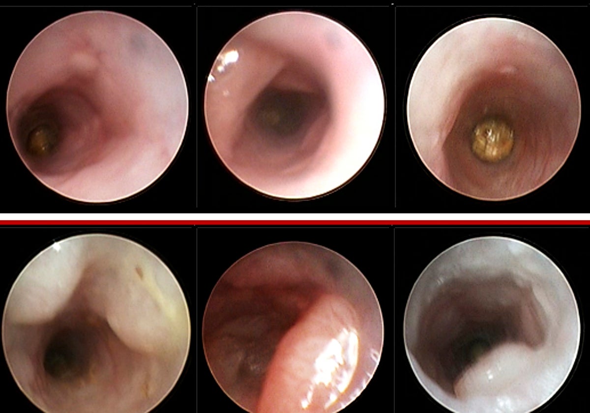 En comparación con ratones normales (arriba), las colonoscopias detectan más tumores y más grandes en los intestinos de ratones con hematopoyesis clonal (abajo)