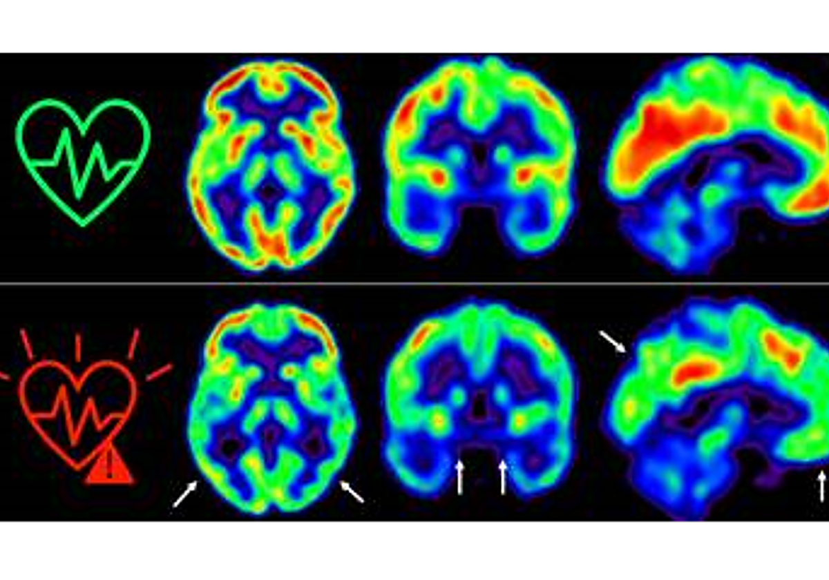 Las imágenes representan la captación de glucosa en cerebro medida por tomografía por emisión de positrones en individuos de mediana edad con bajo (arriba) o alto (abajo) riesgo cardiovascular sostenido a lo largo de 5 años. Los colores representan el consumo de glucosa cerebral, con rojo indicando un consumo más alto y azul más bajo.