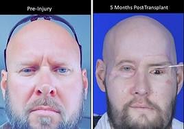 Primer trasplante completo de ojo y de cara parcial del mundo