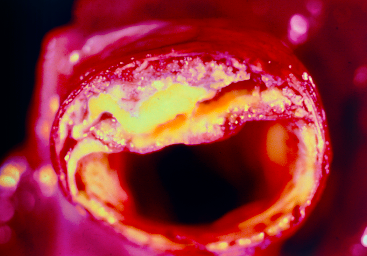 Acumulación en grasas en la arteria