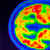 Un cóctel de fármacos para la hipertensión, eficaz en lesiones cerebrales graves