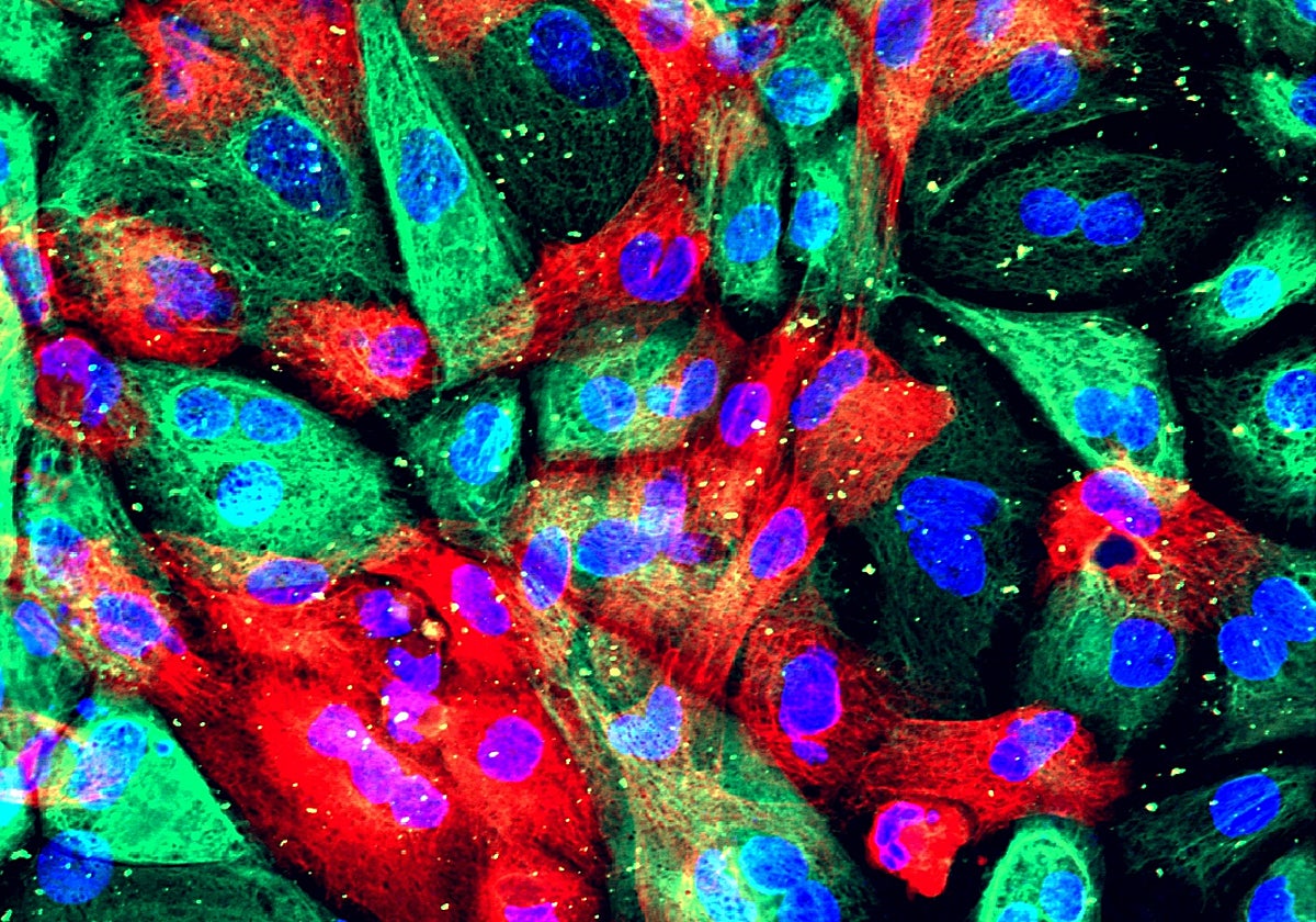 Células de cáncer próstata