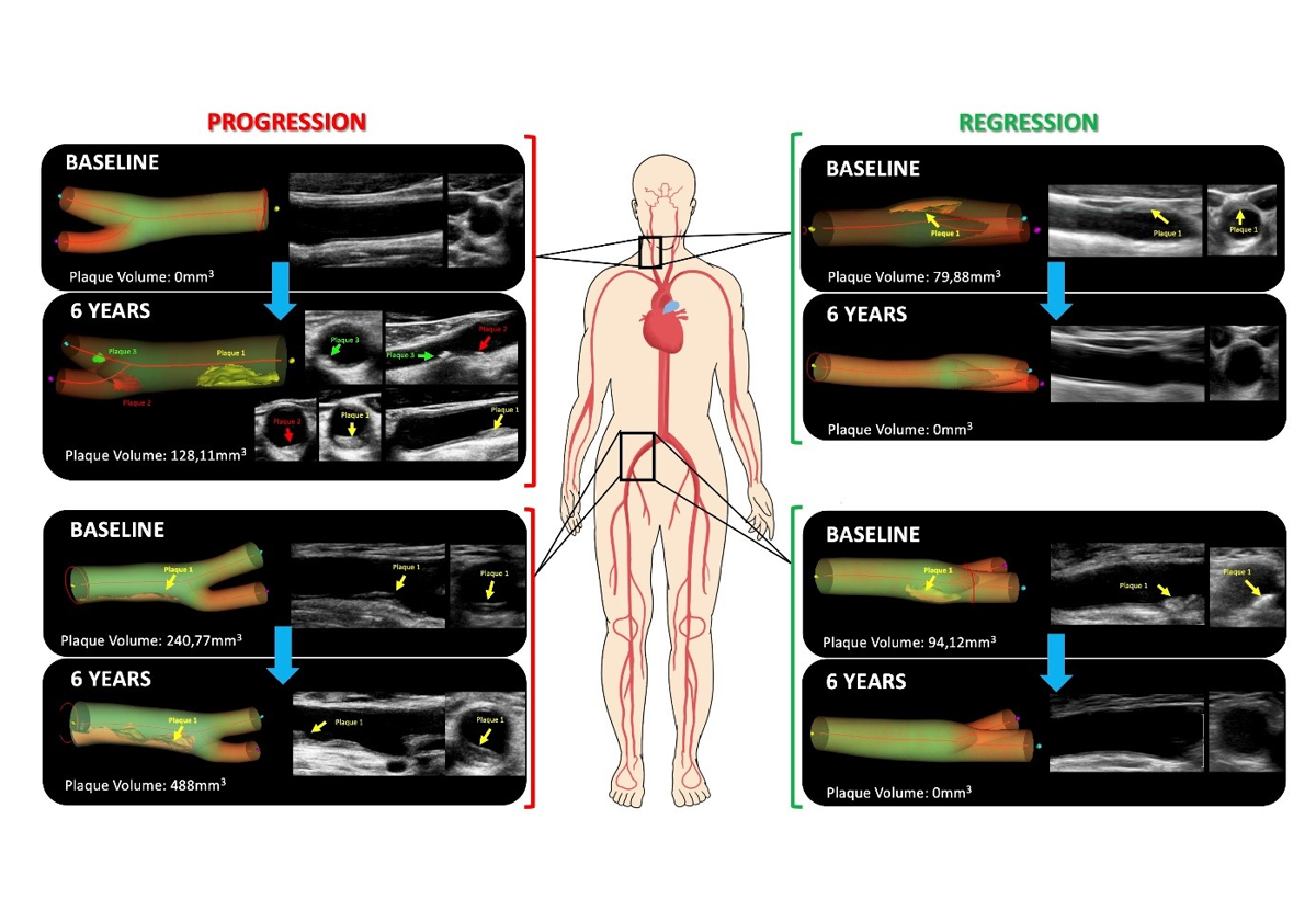 A Spanish study suggests that atherosclerosis can be reversed