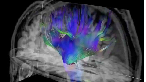 Resonancia magnética del cerebro