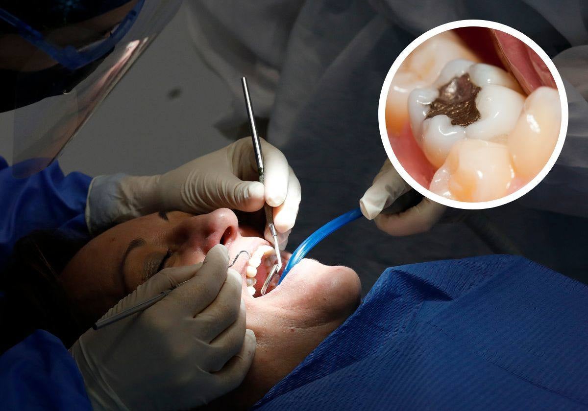 Una paciente durante una intervención dental. En el detalle, un empaste de plata oxidado