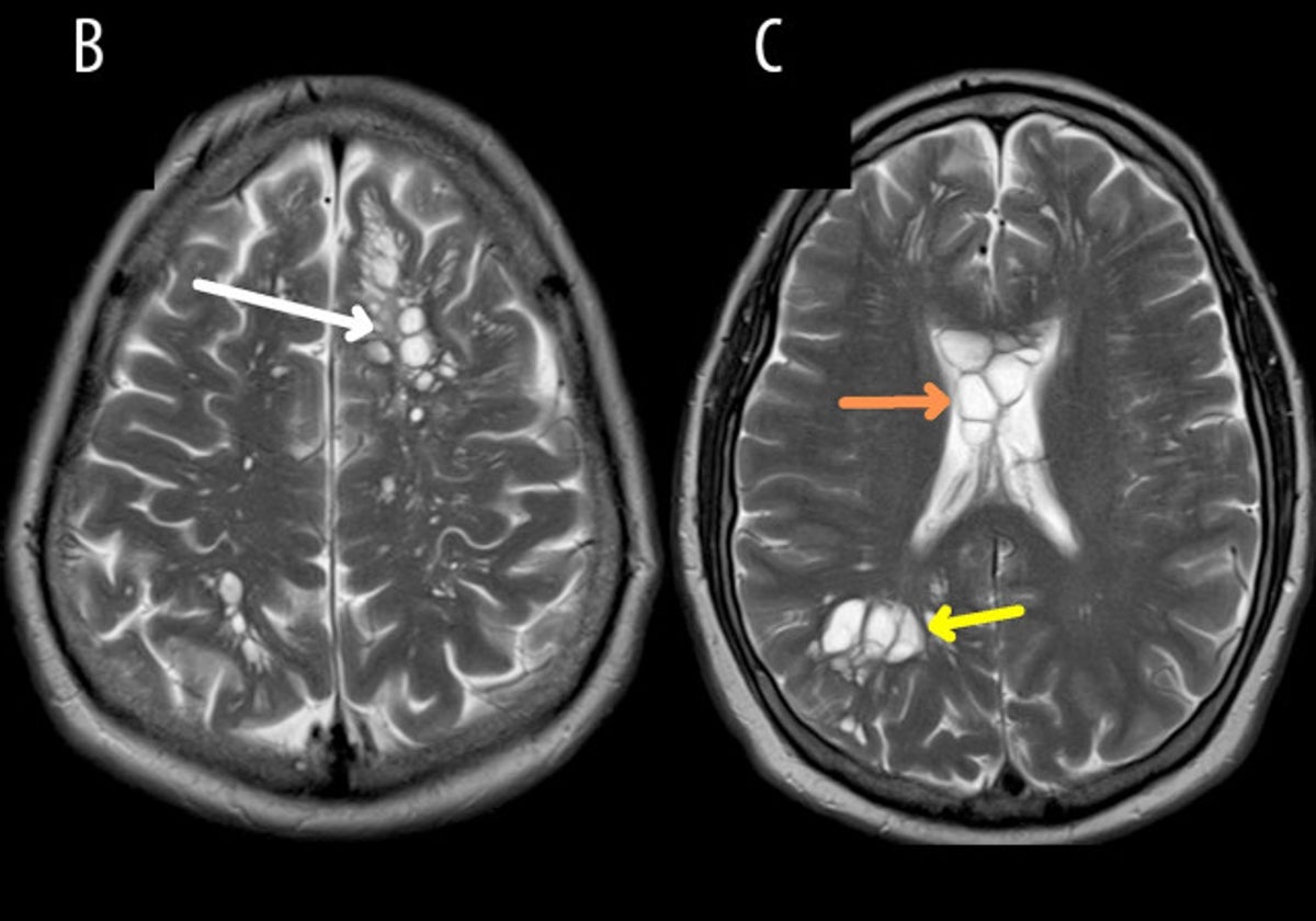 La neuroimagen confirmó los quistes de tenia en el cerebro