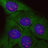 Acumulación de «proteínas basura»: Células normales (izquierda) y células sometidas al efecto de la proteína tóxica rica en arginina (derecha). En esta se incrementan las proteínas ribosomales (verde fluorescente) y el tamaño de los nucléolos (rojo).