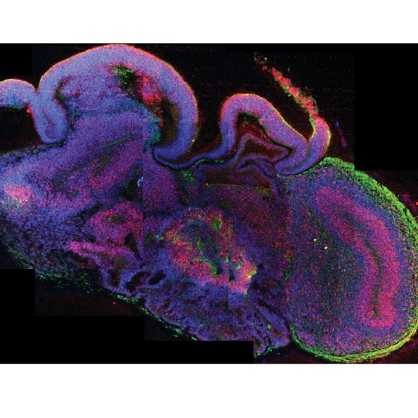 Curan un enfermedad rara gracias al uso de cerebros de laboratorio