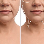 Cinco tratamientos para eliminar la papada (o no tenerla nunca)