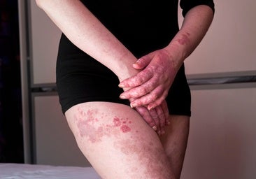 Vivir con lupus: «A pesar de lo devastador de la enfermedad, poco a poco me hago amiga de mi 'lobo'»