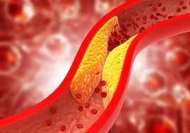 Recreación de una arteria obstruida por placas de colesterol