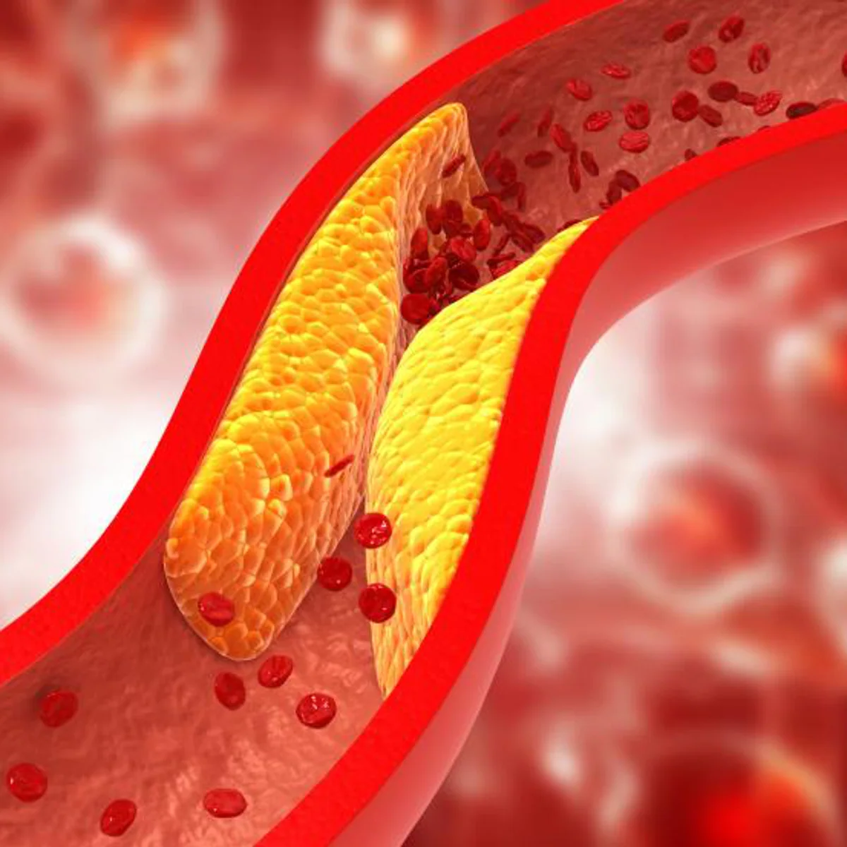 Recreación de una arteria obstruida por placas de colesterol