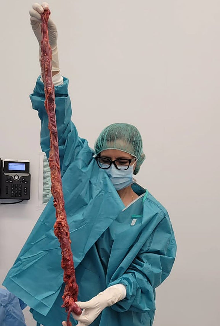 El colon extirpado de África, tras la intervención