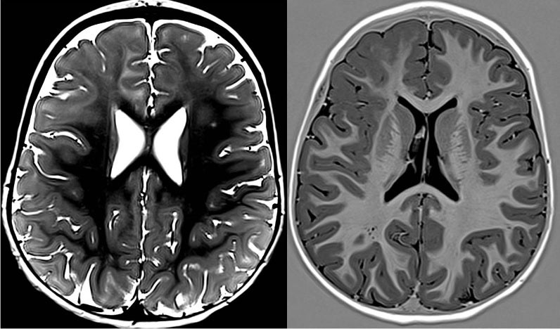 El «MOGHE» («Mild malformation of cortical development with oligodendroglial hyperplasia and epilepsy») es una entidad recientemente descrita que causa epilepsia frontal refractaria en la edad pediátrica.