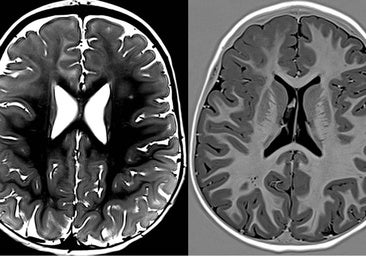 El Hospital Ruber Internacional participa en la identificación de un nuevo tipo de epilepsia: MOGHE