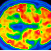 La UE aconseja no aprobar lecanemab, un fármaco controvertido para el alzhéimer
