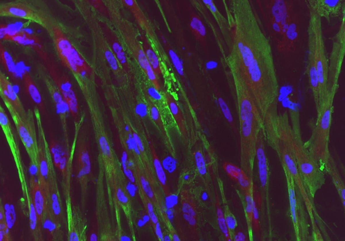 Imagen de la proteína distrofina en pacientes con distrofia muscular de Duchenne (DMD), una de las patologias causadas por estas mutaciones