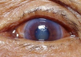 ¿Tienes más  55 años? Vigila tu colesterol 'bueno', podría favorecer el glaucoma