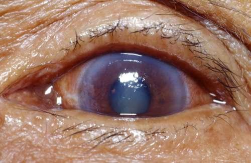Ojo con glaucoma