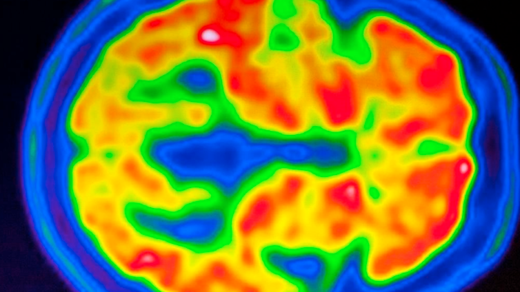 La esquizofrenia se refleja en la estructura cerebral de cada persona