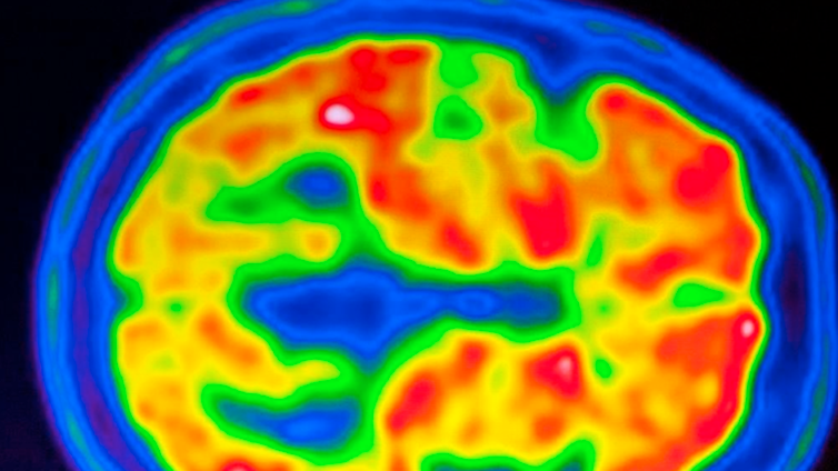 La relación de la enfermedad del beso con la esclerosis múltiple está en tus genes