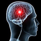 Qué hay detrás de los ictus inexplicables en menores de 50 años