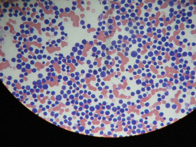 Células de leucemia