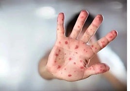 Sarampión: ¿cómo hacer frente al aumento del número de casos?
