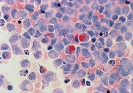 Este es el cáncer 'olvidado' que más aumenta entre los jóvenes