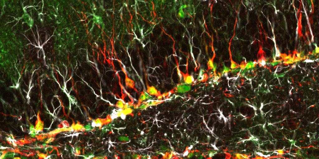 骨髄移植は、8人の患者でまれな病気を止めます