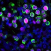 La infección por el virus de la influenza (gripe) provoca el despertar y la expansión de células cancerosas latentes en los pulmones de ratones. Las células cancerosas se muestran en verde y el marcador de proliferación en magenta.