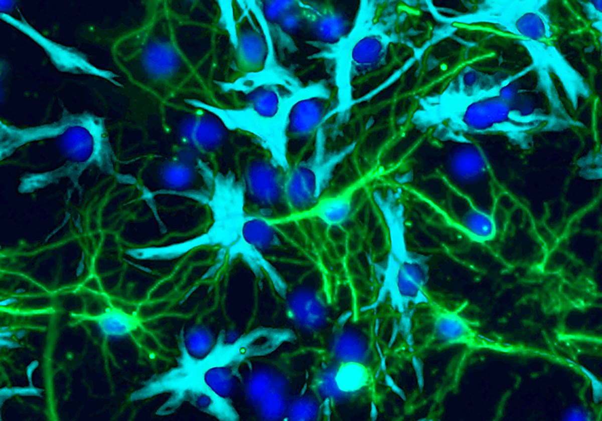 Neuronas (verde) y células tumorales (cian) cultivadas en laboratorio demuestran cómo ambos tipos de células pueden interconectarse a medida que crece un tumor, alterando el desarrollo y la función cerebral