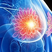 Esta terapia borra las células tumorales dormidas y frena la reaparición del cáncer