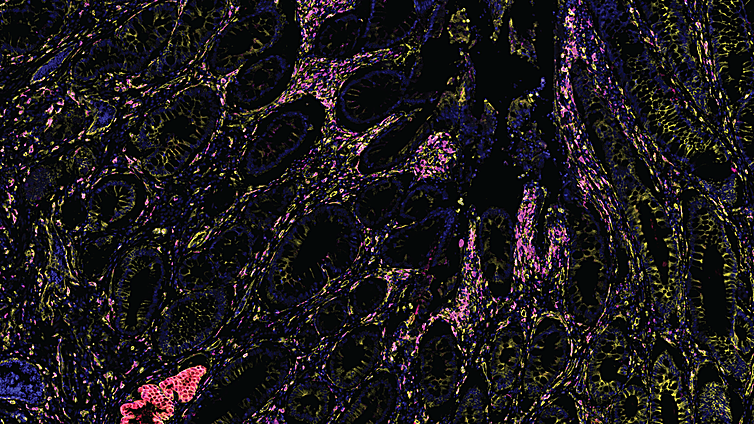 Un microbioma intestinal estable favorece el crecimiento infantil