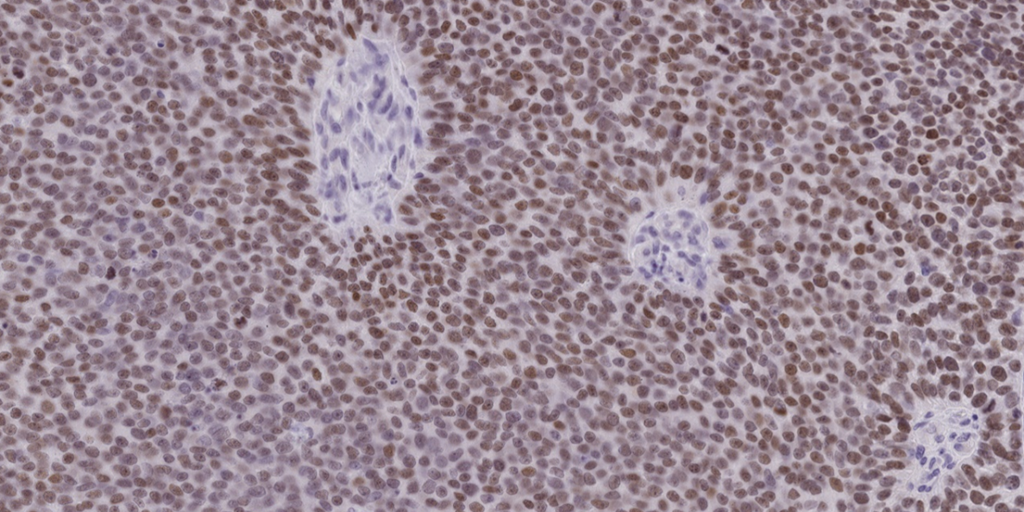La caja negra del cáncer revela el pasado oculto de los tumores y predice su futuro