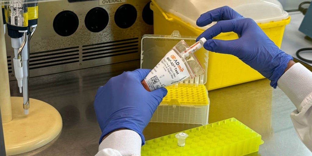 Un análisis de sangre permite anticipar la progresión del alzhéimer