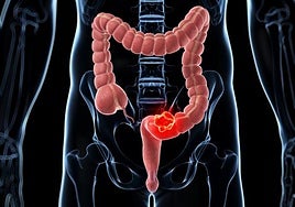 Investigadores españoles descubren por qué la inmunoterapia no funciona en el cáncer colorrectal metastásico
