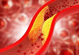 Los médicos internistas avisan: este tipo de colesterol menos conocido pero más nocivo puede causar infartos, ictus y la muerte