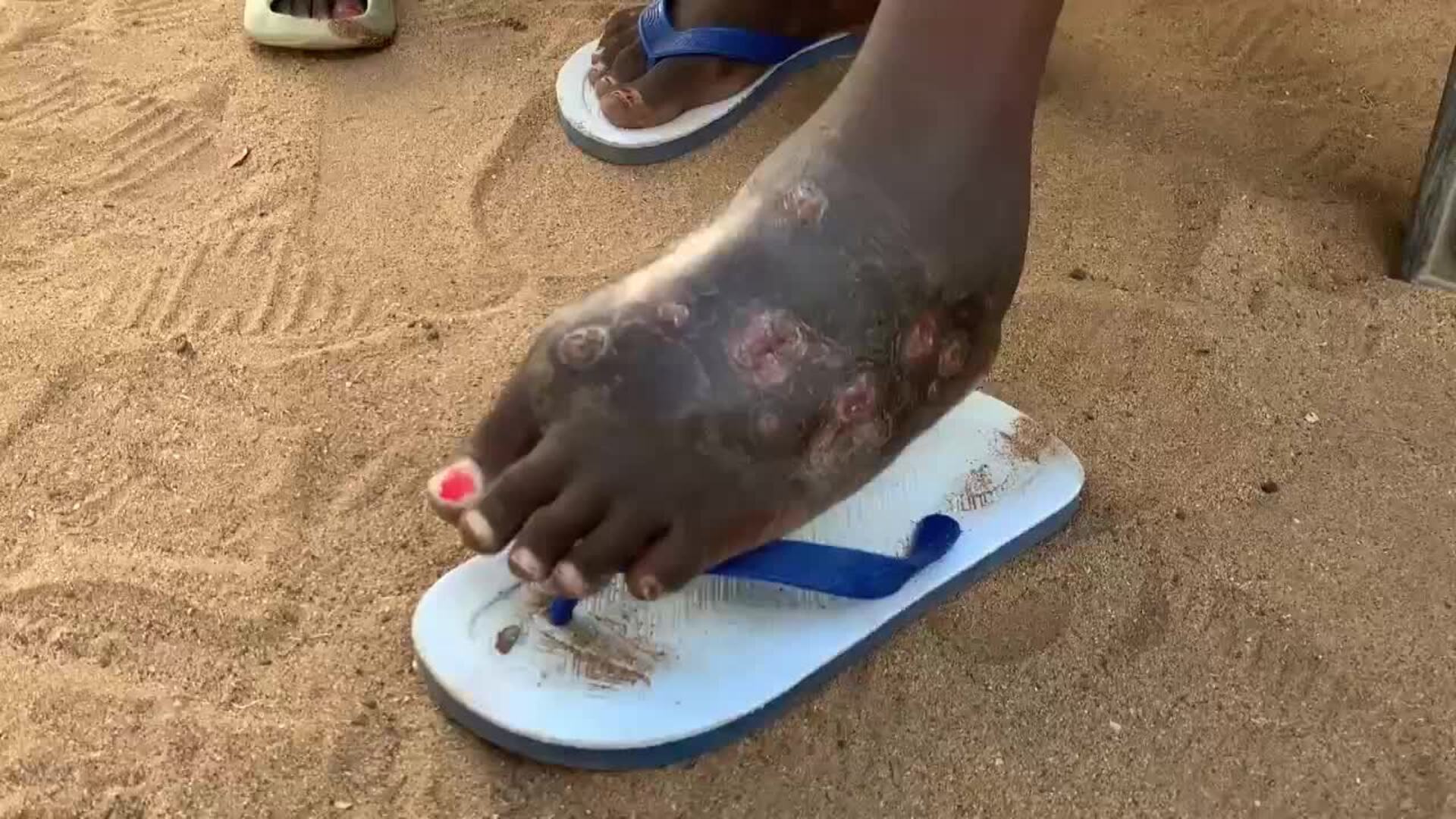 La misteriosa enfermedad ósea que causa estragos entre las comunidades del norte de Kenia