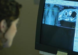 ¿Por qué el cáncer de pulmón crece en no fumadores? «Es otro tumor»
