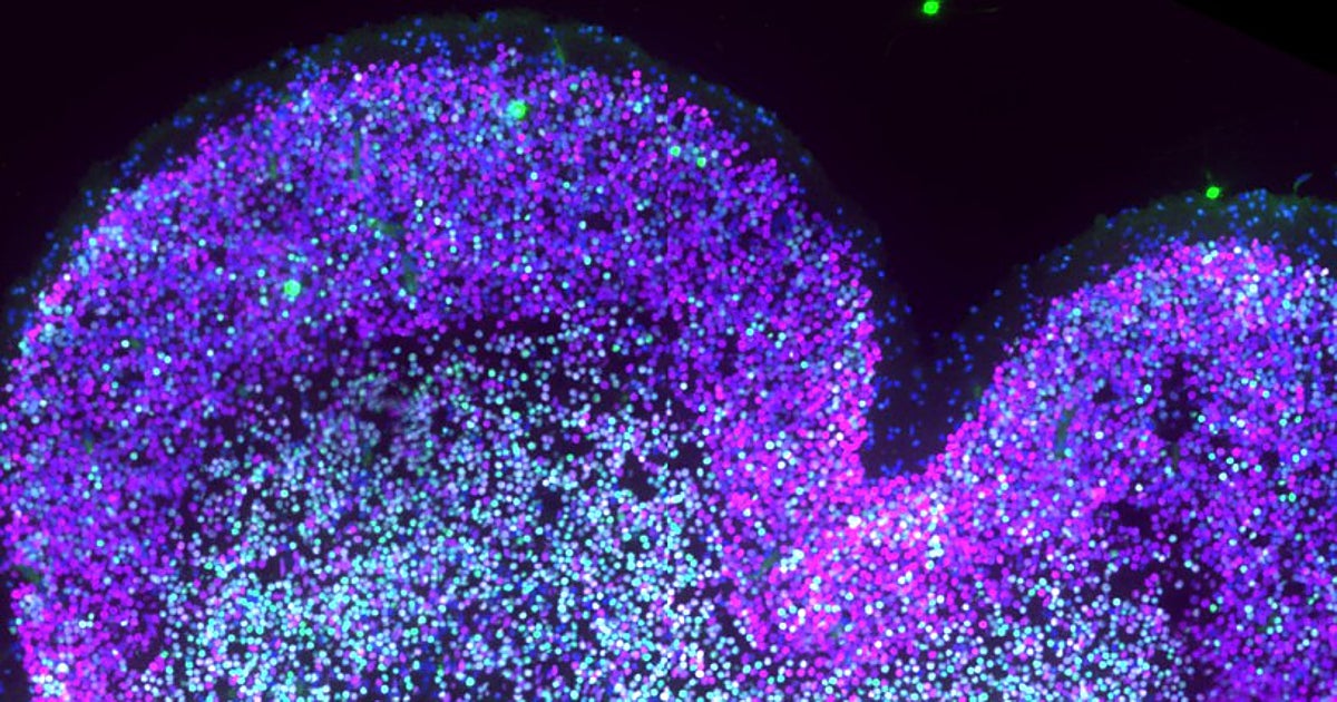 Un atlas molecular revela la «caja negra» del cerebro con síndrome de Down antes del nacimiento