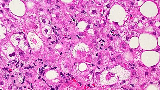 La amenaza silenciosa de la enfermedad hepática: «Europa se enfrenta a una crisis sin precedentes»
