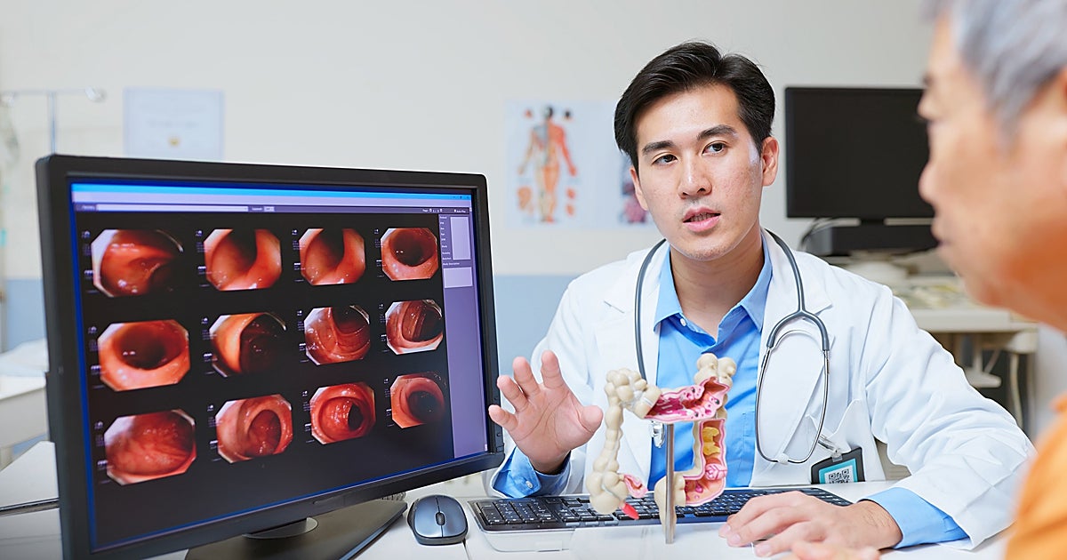 Las nuevas recomendaciones de los oncólogos americanos para detectar antes el cáncer de colon