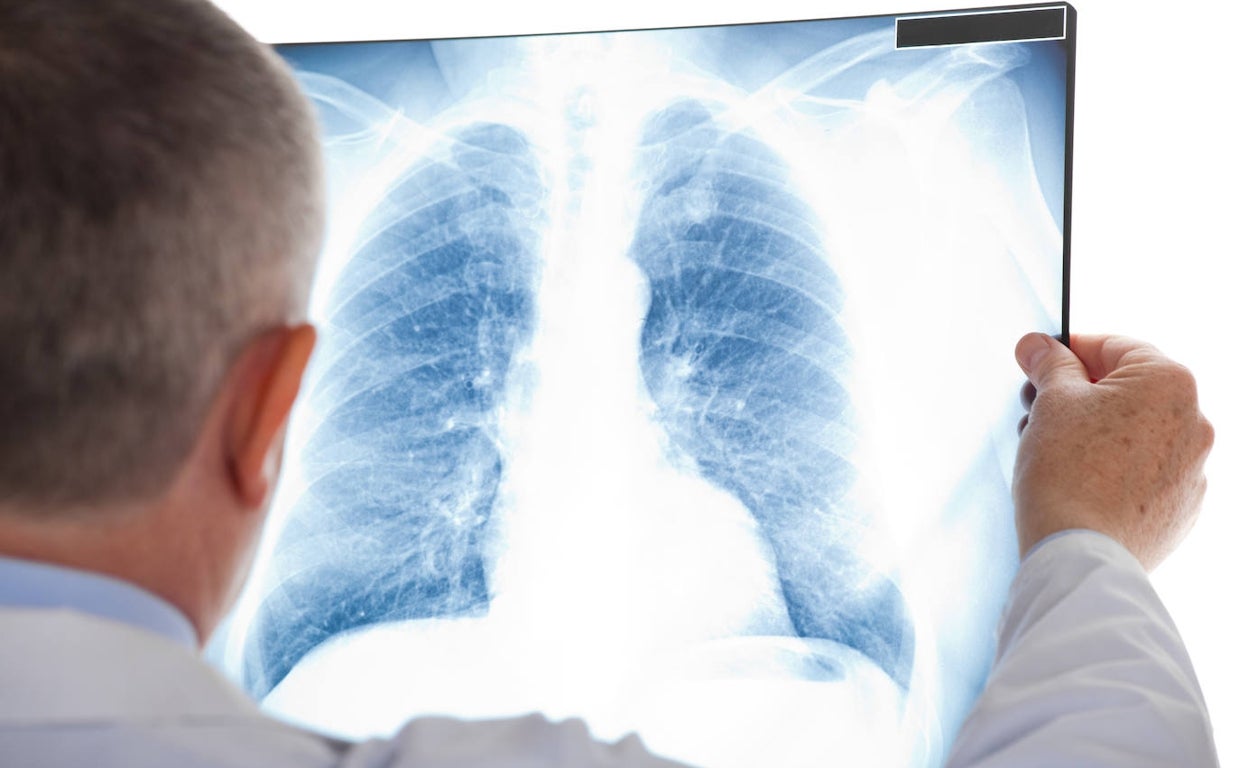Los síntomas del cáncer de pulmón pueden ser inespecíficos