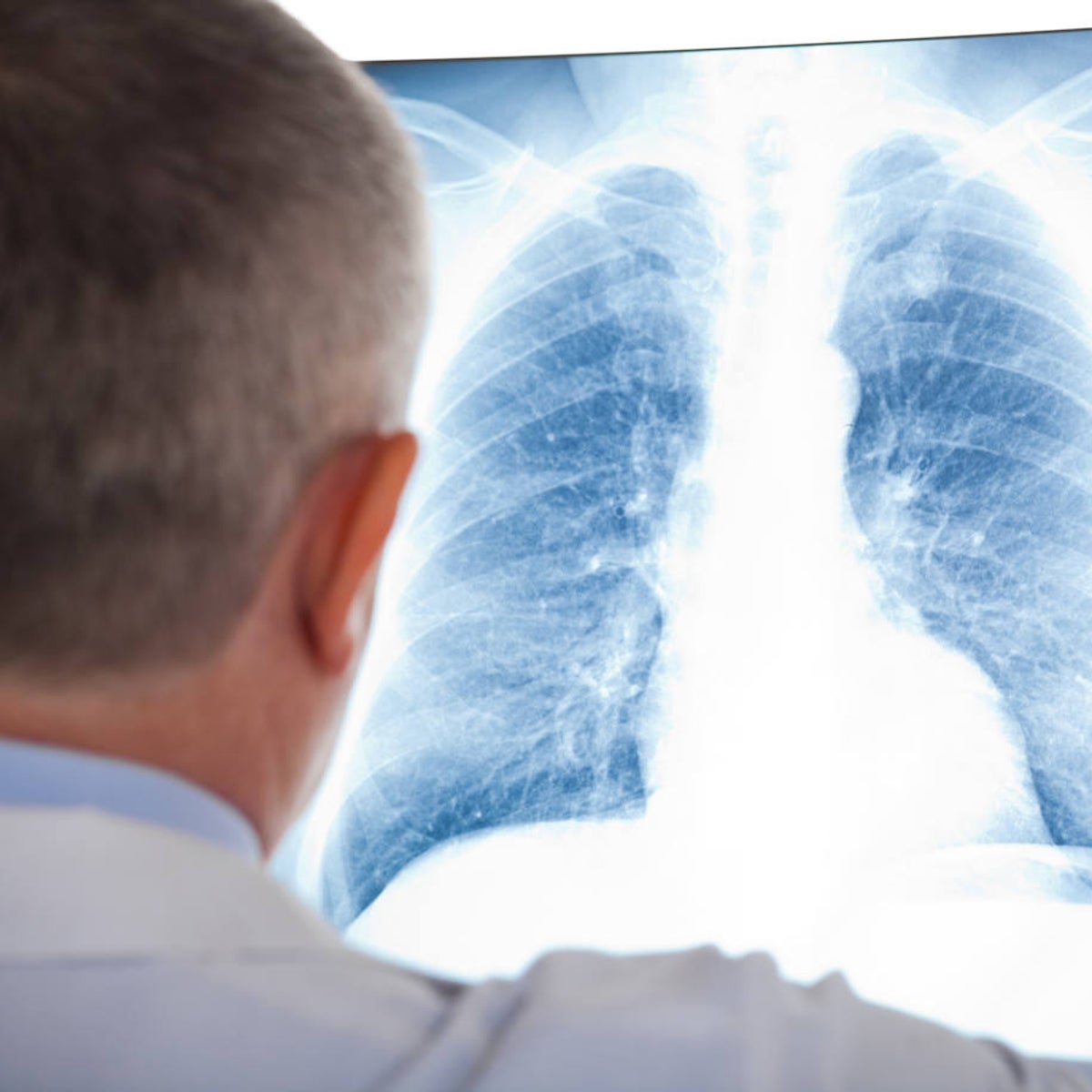 ¿Cuáles son los síntomas más frecuentes y los factores de riesgo del cáncer de pulmón?