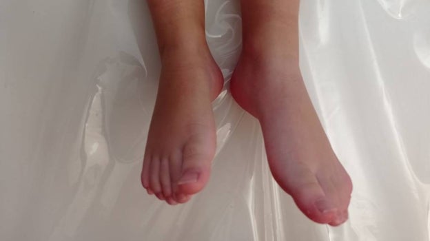 La imagen muestra el diferente tamaño que tienen las piernas del hijo de Verónica y Rafael