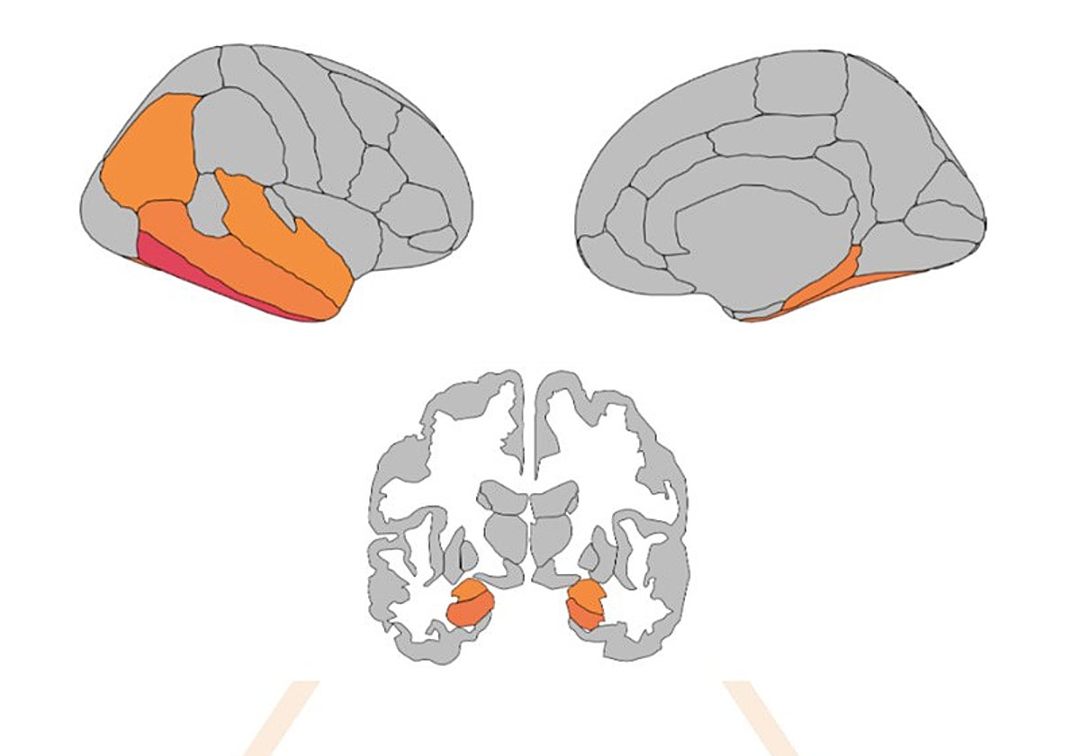 El ejercicio sirve como muro contra el avance del párkinson