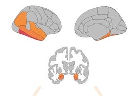 Un estudio de la Universidad de Sevilla prueba que la actividad física ayuda a frenar el deterioro cognitivo del párkinson