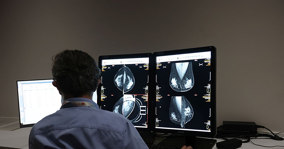 El cáncer de mama más agresivo se debate en Sevilla: «Sigue huérfano de terapias eficaces»